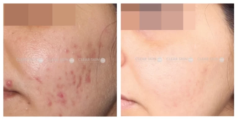 Acne-Scars-Before-And-After