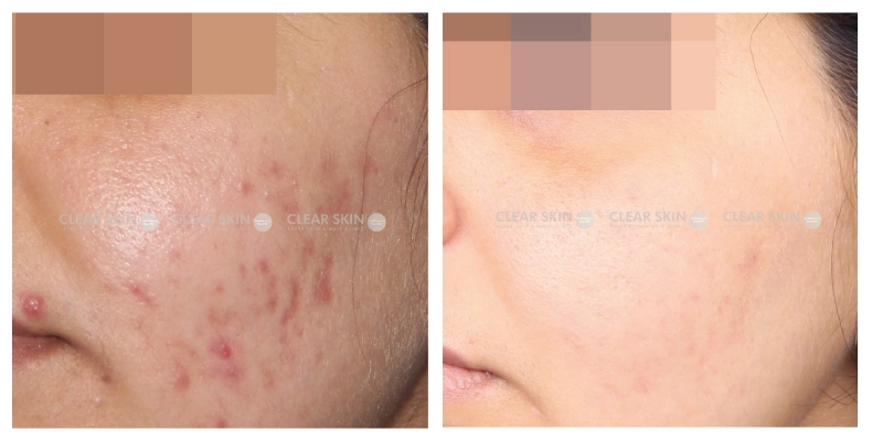 Acne-Scars-Before-And-After