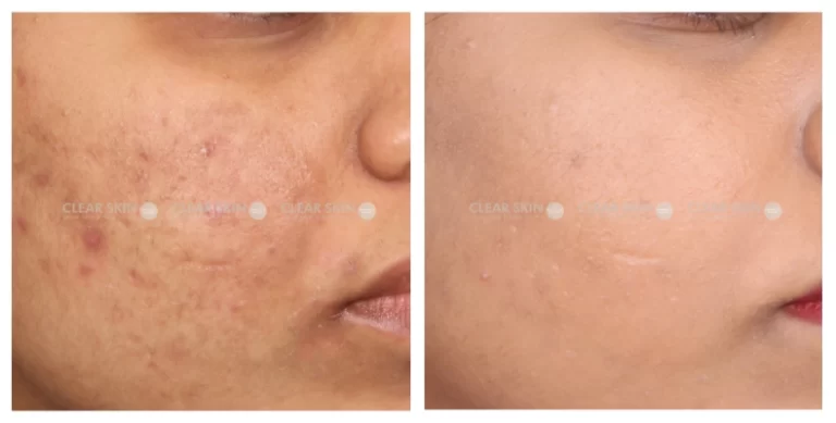 Acne-Scars-Before-And-After