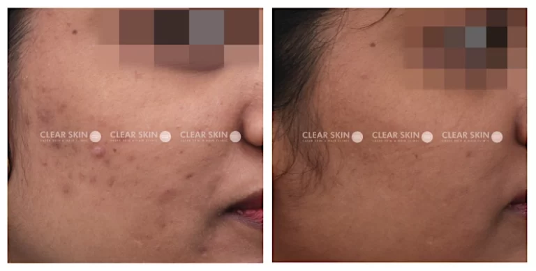 Acne-Scars-Before-And-After
