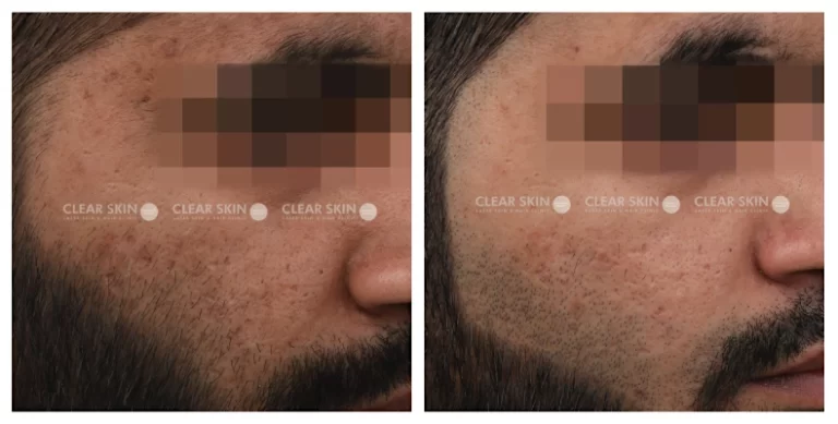 Acne-Scars-Before-And-After