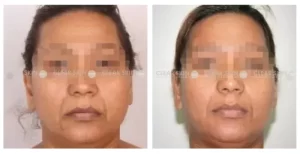 Anti-Aging-before-after-result