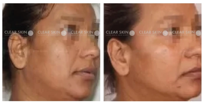 Anti-Aging-before-after-result1