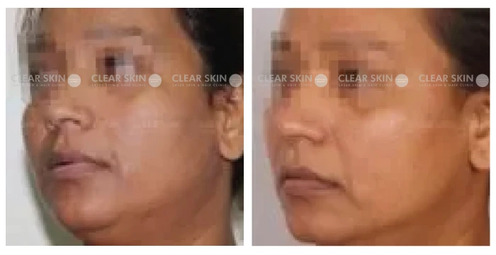 Anti-Aging-before-after-result2