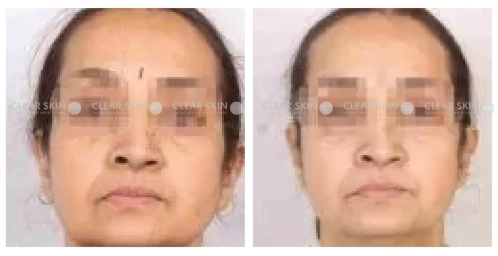 Anti-Aging-before-after-result3