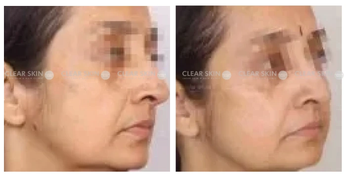 Anti-Aging-before-after-result4