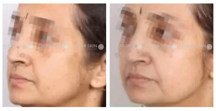 Anti-Aging-before-after-result5